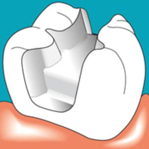 Стоматологические вкладки